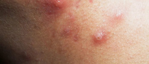 Заразен ли чирей?