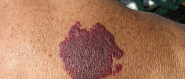 Размеры родимого пятна