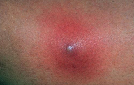 Фурункул под кожей