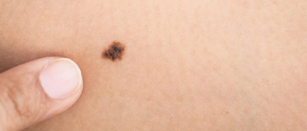 Что значит когда появляется родинка?