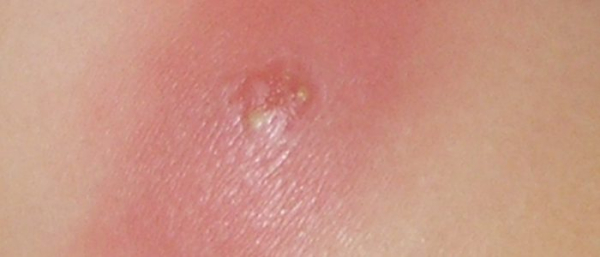 Боль из-за фурункула