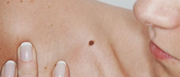 Отличие родинок и бородавок