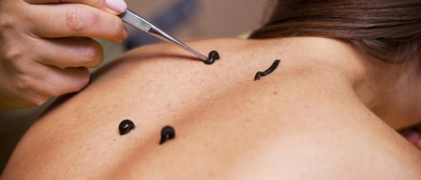 Пиявки при фурункулах