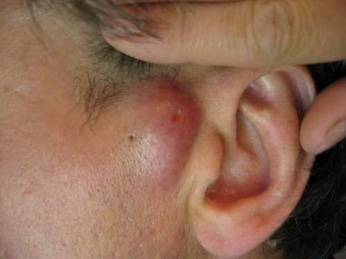 Фурункул слухового прохода