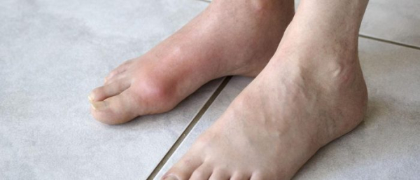 Фурункул на ноге