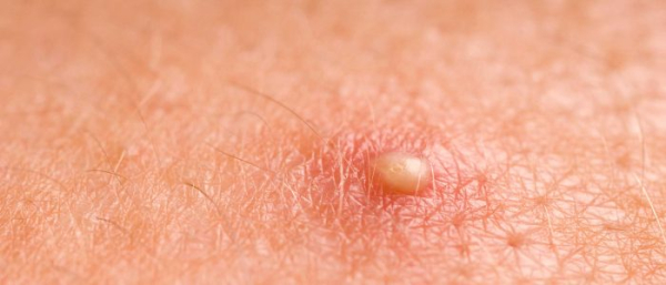 Как отличить прыщ от фурункула?