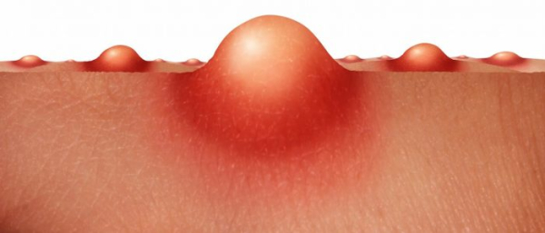 Чем отличается фурункул от чирия?