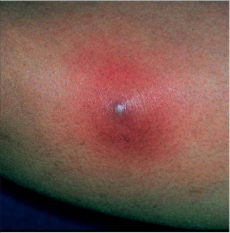 Как избавиться от фурункула в домашних условиях?