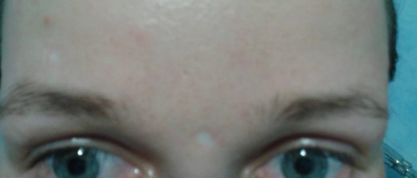 Рубец после удаления родинки