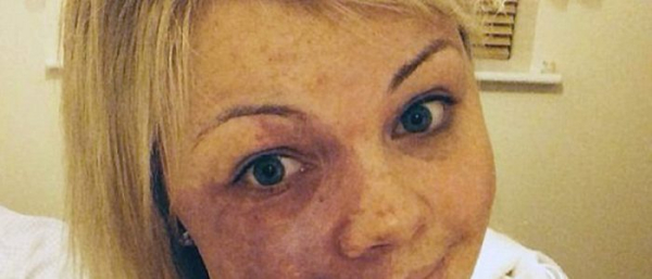 Родимые пятна