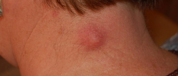 Чирей на шее