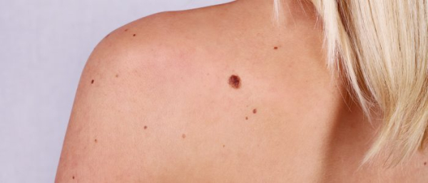 Папилломы и родинки на коже