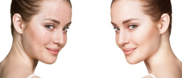 Ретинол при прыщах