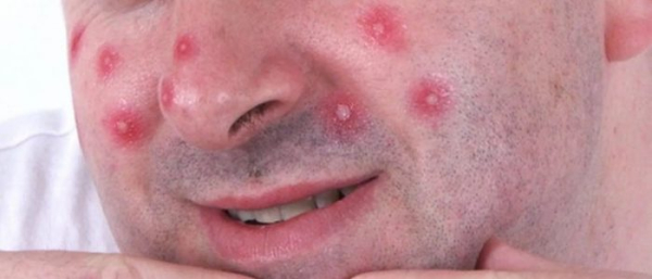 Как выдавить фурункул?