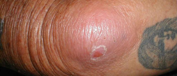 Чирей на локте