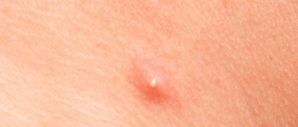 Чирей у человека