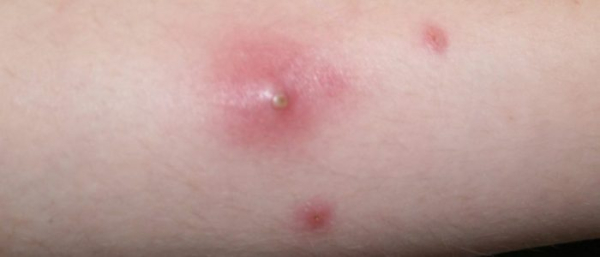 Лечение фурункулов при диабете