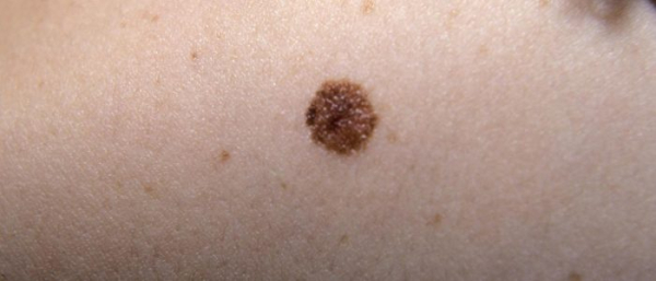 Родимые пятна и бородавки