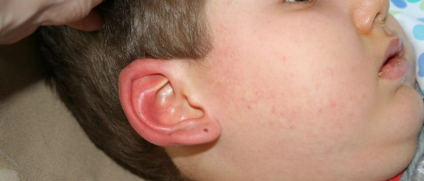 Чирий у детей