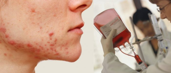 Переливание крови при прыщах